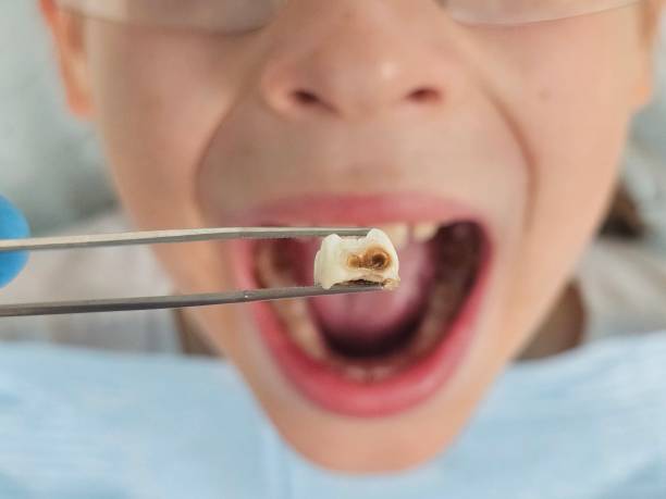 Best Emergency Treatment for Dental Infections or Abscesses in Oakdale, CA