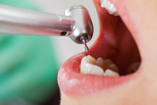 Best Emergency Dental Care for Broken or Chipped Teeth in Oakdale, CA